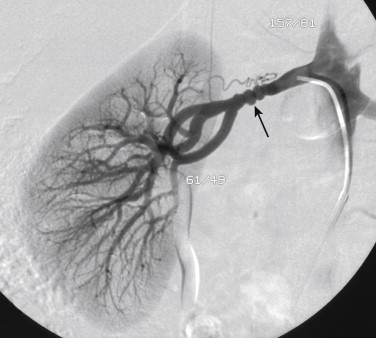 Figure 1-11, Fibromuscular dysplasia (FMD). Selective right renal artery digital subtraction angiogram in a 48-year-old woman. The irregular beaded appearance (arrow) and location of the abnormality in the distal main renal artery is typical of FMD of the medial fibroplasia type.