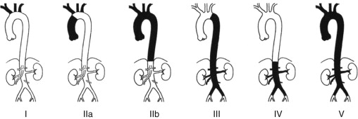 Figure 1-12, Classification scheme of angiographic findings in Takayasu arteritis. The letter “C” is added when coronary artery involvement is present, and the letter “P” when pulmonary arteries are involved.