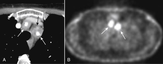 Figure 1-13, Takayasu arteritis involving the carotid arteries in a middle-aged woman. A, Contrast-enhanced computed tomography scan showing thickened arterial walls of the innominate and left subclavian arteries (white arrows). The left common carotid artery is occluded (black arrow). B, PET scan at same level showing activity in the thickened arterial walls (white arrows).