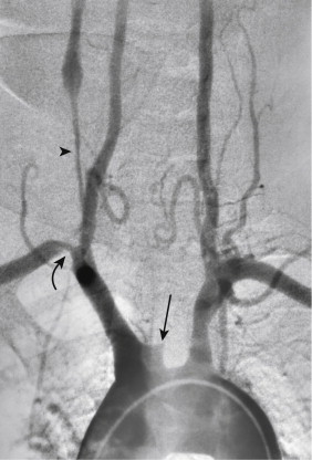 Figure 1-14, DSA arch aortogram showing occlusion of the left CCA (arrow) at the origin (bovine arch), long stenosis of the right CCA (arrowhead), and stenosis of the right subclavian artery origin (curved arrow) .