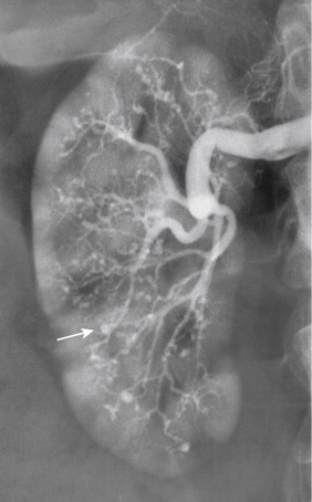 Figure 1-15, Polyarteritis nodosa. Angiogram of the right kidney shows numerous small peripheral aneurysms (arrow). These were present in the left kidney as well.