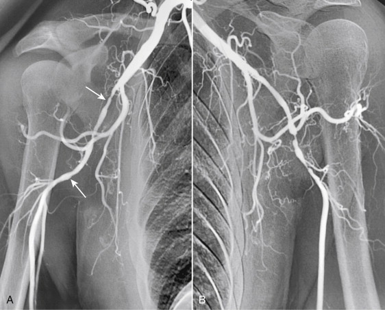 Figure 1-16, Giant cell arteritis in a middle-aged male with bilateral upper-extremity claudication and an elevated erythrocyte sedimentation rate. The aortic arch and subclavian arteries were normal. A, Digital angiogram showing irregular narrowing of the distal right axillary artery and proximal brachial arteries (arrows). B, The same findings are present on the left. The distal arteries were normal in both arms.