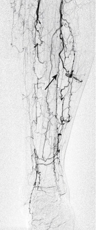 Figure 1-17, Buerger disease. Detailed view of digital subtraction angiogram of the calf of a 34-year-old male smoker. There are no patent named arteries. There are numerous coiled collateral arteries, including one in the vasa vasorum of the occluded posterior tibial artery (arrow).