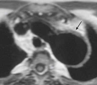 Figure 1-18, Behçet disease. Axial T1 weighted image of the aortic arch in a young female with a focal aneurysm of the proximal descending thoracic aorta (arrow).