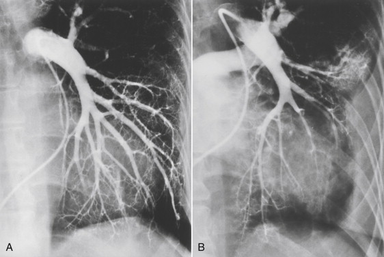 Figure 1-19, Radiation arteritis. A, Normal pulmonary angiogram of the left lung. B, Left pulmonary angiogram from the same patient obtained 7 years after radiation treatment for breast carcinoma shows narrowing, branch vessel occlusions and pleural thickening consistent with late radiation fibrosis.