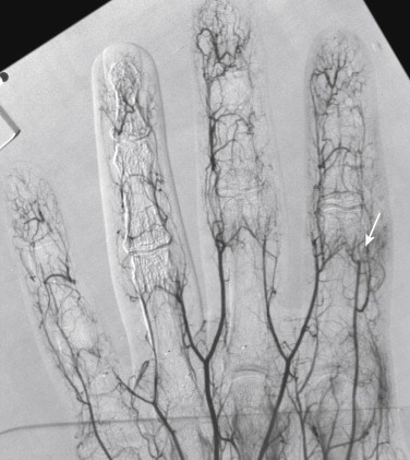 Figure 1-20, Systemic lupus erythematosus in a teenaged female with bilateral digital ulcers. Detail of a magnified, subtracted angiogram of the hand shows areas of digital artery narrowing with multiple occlusions (arrow). There are no intraluminal filling defects or other evidence of emboli.