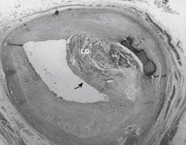 Figure 1-2, Atheromatous plaque. Eccentric atheroma, with thin fibrous cap (arrow) overlying necrotic lipid core (LC) (H&E × 50).