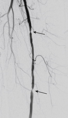 Figure 1-3, Angiographic appearance of concentric stenoses of the left superficial femoral artery (arrows).