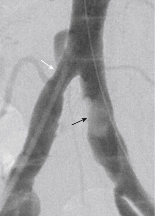 Figure 1-4, Angiographic appearance of bulky, eccentric plaque (black arrow) in the left common iliac artery. Compare this to the concentric stenosis of the right common iliac artery (white arrow).