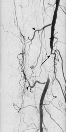 Figure 1-6, Hypertrophied collateral arteries around a short chronic occlusion of the distal superficial femoral artery. Digital subtraction angiogram shows enlarged muscular branches (arrowheads) providing flow around the occlusion with reconstitution of the above-knee popliteal artery. Note the tapered contour of the lumen at the occlusion (arrow), which occurs just distal to a muscular branch.