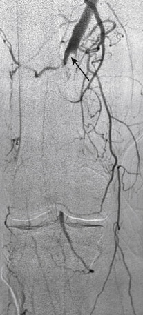 Figure 1-7, Poor collateral arterial supply around an acute occlusion due to thrombosis of a popliteal artery aneurysm. Digital subtraction angiogram shows an abrupt cutoff of flow with a filling defect (arrow) consistent with thrombus. There is a paucity of collateral vessels and lack of reconstitution of distal vessels.