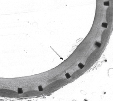 Figure 1-8, Intimal hyperplasia. Low-power micrograph shows thickened intima (arrow) lining the luminal surface of a metallic stent 6 months after placement in an external iliac artery.