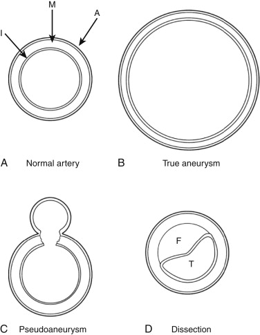 Figure 1-9, Diagram illustrating the differences between true aneurysms, false aneurysms, and dissections. A, The normal artery has three intact layers: I, intima; M, media, A, adventitia. B, True aneurysm. All three layers of the arterial wall remain intact, although there is thinning of the media. C, Pseudoaneurysm. In this drawing, there is disruption of the intima and media, with formation of a saccular aneurysm contained by the adventitia. D, Dissection. All three layers are essentially intact, and the artery may be normal in caliber, but the intima has separated from the media, dividing the artery into two channels (T, true lumen; F, false lumen). The false lumen may be patent or thrombosed. When patent, it is frequently larger than the true lumen.