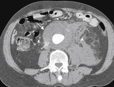 Figure 1-10, Computed tomography scan with contrast of a ruptured abdominal aortic aneurysm (arrow). The lumen of the aneurysm is lined with mural thrombus (open arrow). There is a hematoma in the periaortic soft tissues (arrowhead).