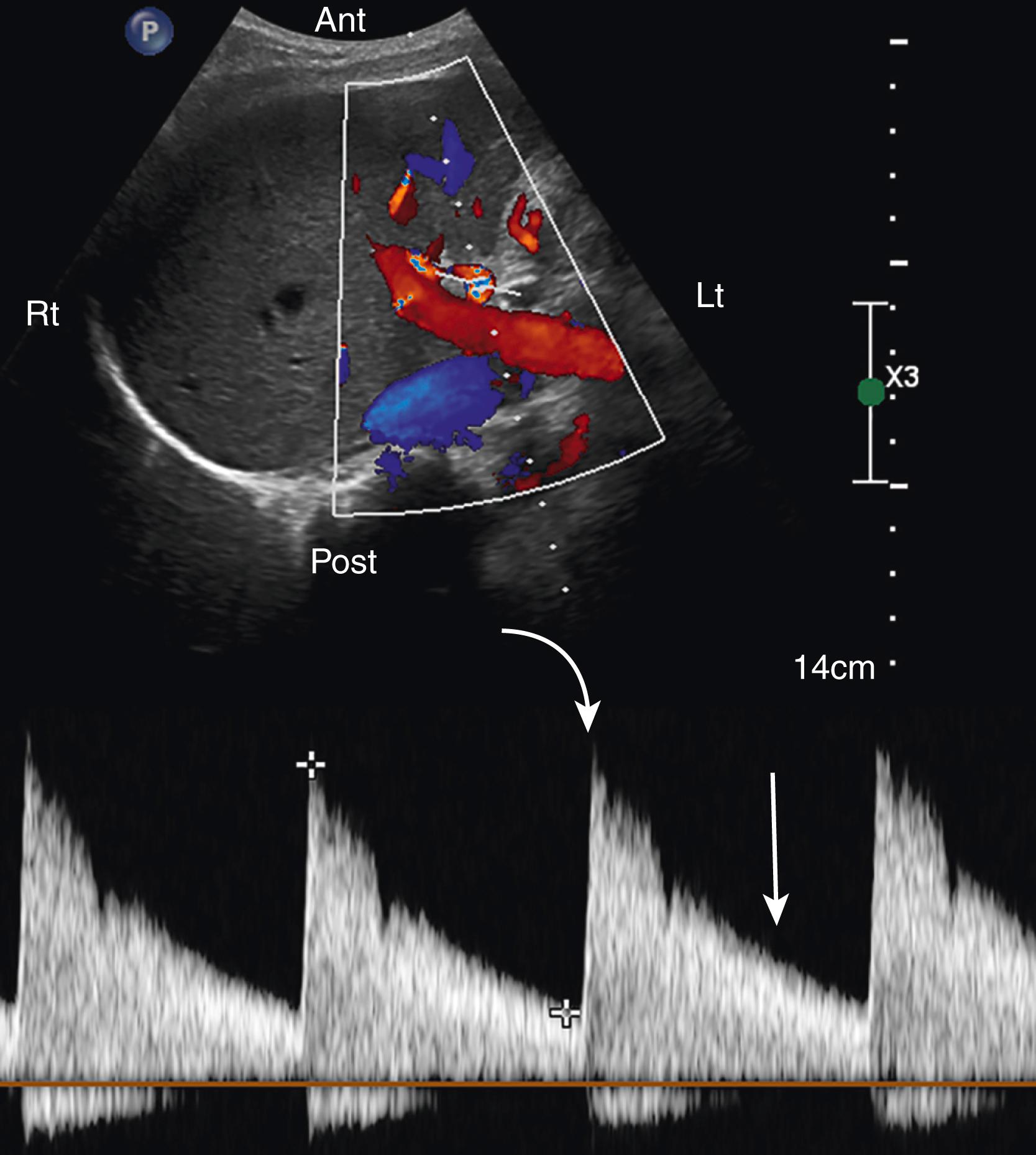 Fig. 19.3, Normal Color and Spectral Doppler Images of the Hepatic Artery: Low Resistance.