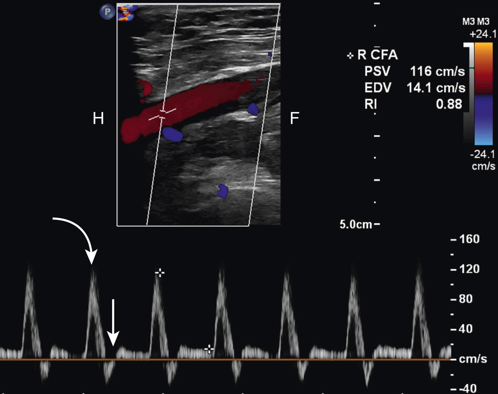 Fig. 19.4, Normal Color and Spectral Doppler Images of Common Femoral Artery: High Resistance.