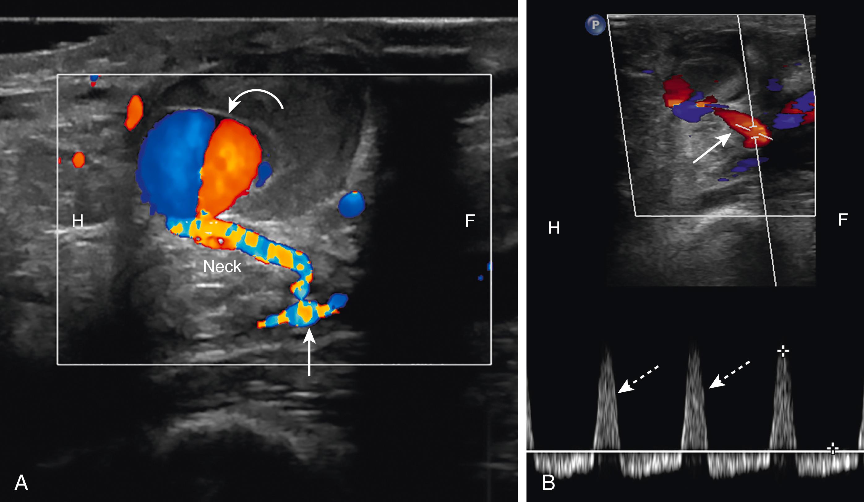 Fig. 19.6, Color and Spectral Doppler Images of a Pseudoaneurysm.
