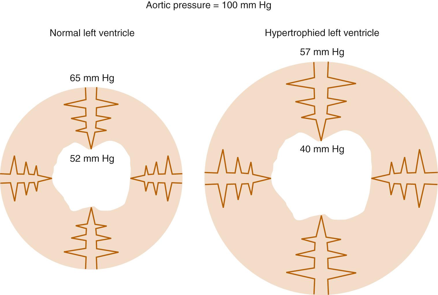 FIGURE 48-3, Transmural losses of coronary perfusion pressure in normal and hypertrophied hearts. Pressures were measured using micropuncture–servo null techniques in hearts perfused via the left main coronary artery at 100 mm Hg.