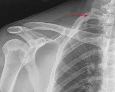 Fig. 55.11, A shoulder radiograph showing a cervical rib (arrow) .