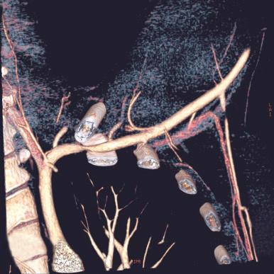 Fig. 55.12, Computed tomographic angiography with the arm in abduction shows subclavian artery compression in this position.