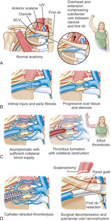 Fig. 55.14, A review of the pathophysiology and treatment of venous thoracic outlet syndrome. IJV, Internal jugular vein; SCV, subclavian vein.