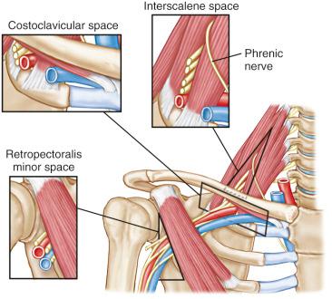 Fig. 55.2, Three spaces in the thoracic outlet that may be responsible for thoracic outlet syndrome.