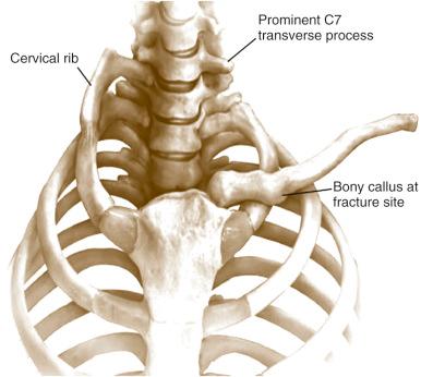 Fig. 55.4, Common bony anomalies in persons with thoracic outlet syndrome.