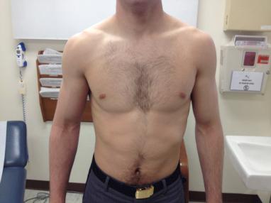 Fig. 55.5, Presentation of a patient with venous thoracic outlet syndrome. Note the engorged superficial veins overlying the right chest.