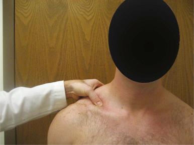 Fig. 55.7, The supraclavicular pressure test is performed by placing compression in the retroclavicular space with the thumb in an attempt to compress the brachial plexus and vascular structures.