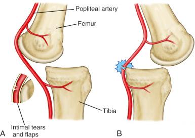 Fig. 109.2, Mechanisms of popliteal artery injury after knee dislocation.