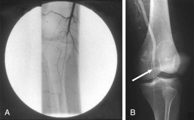 Fig. 109.3, Arterial injury after a knee dislocation.