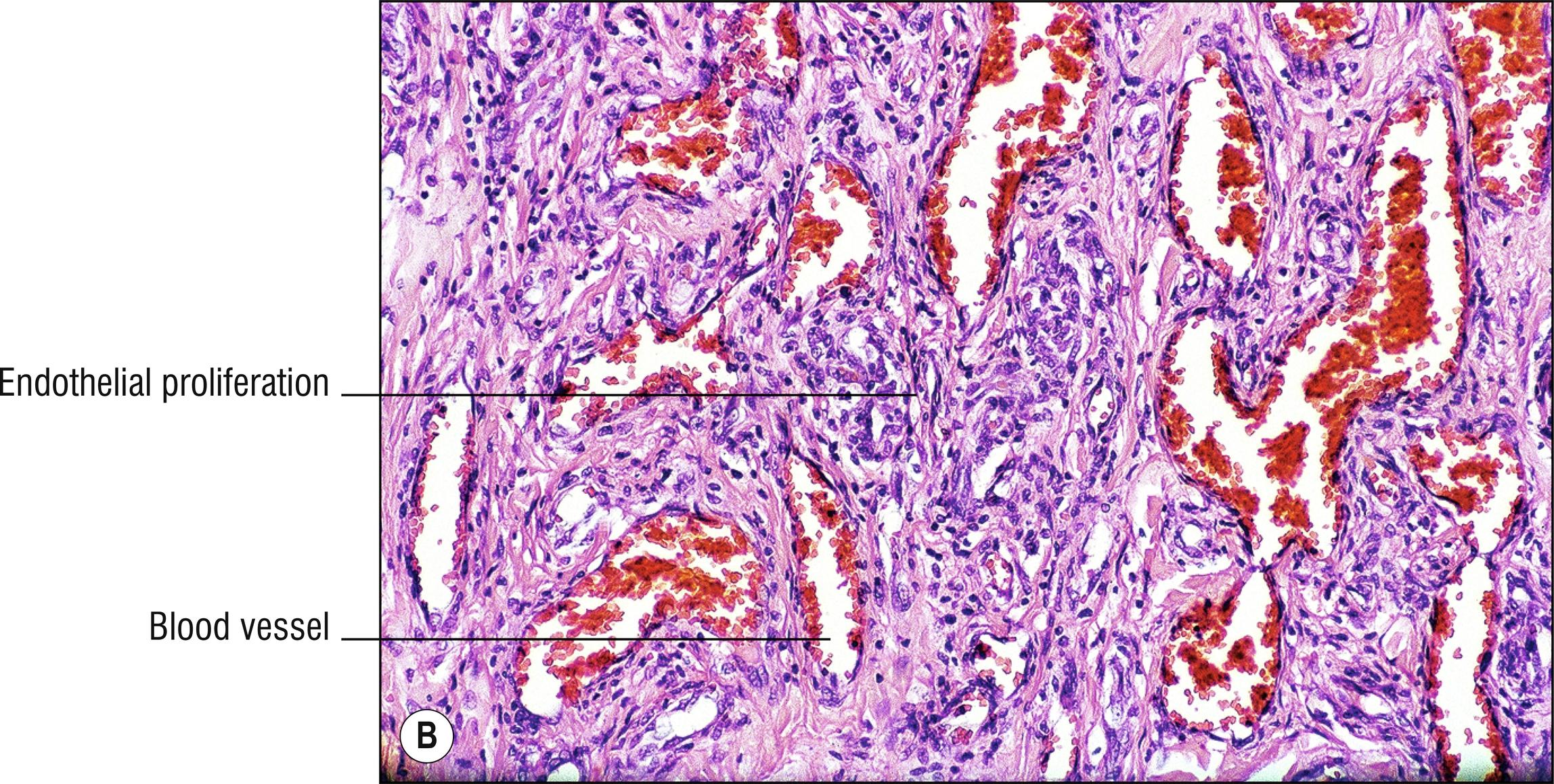 Fig. 25.1, B Hemangioma of infancy.