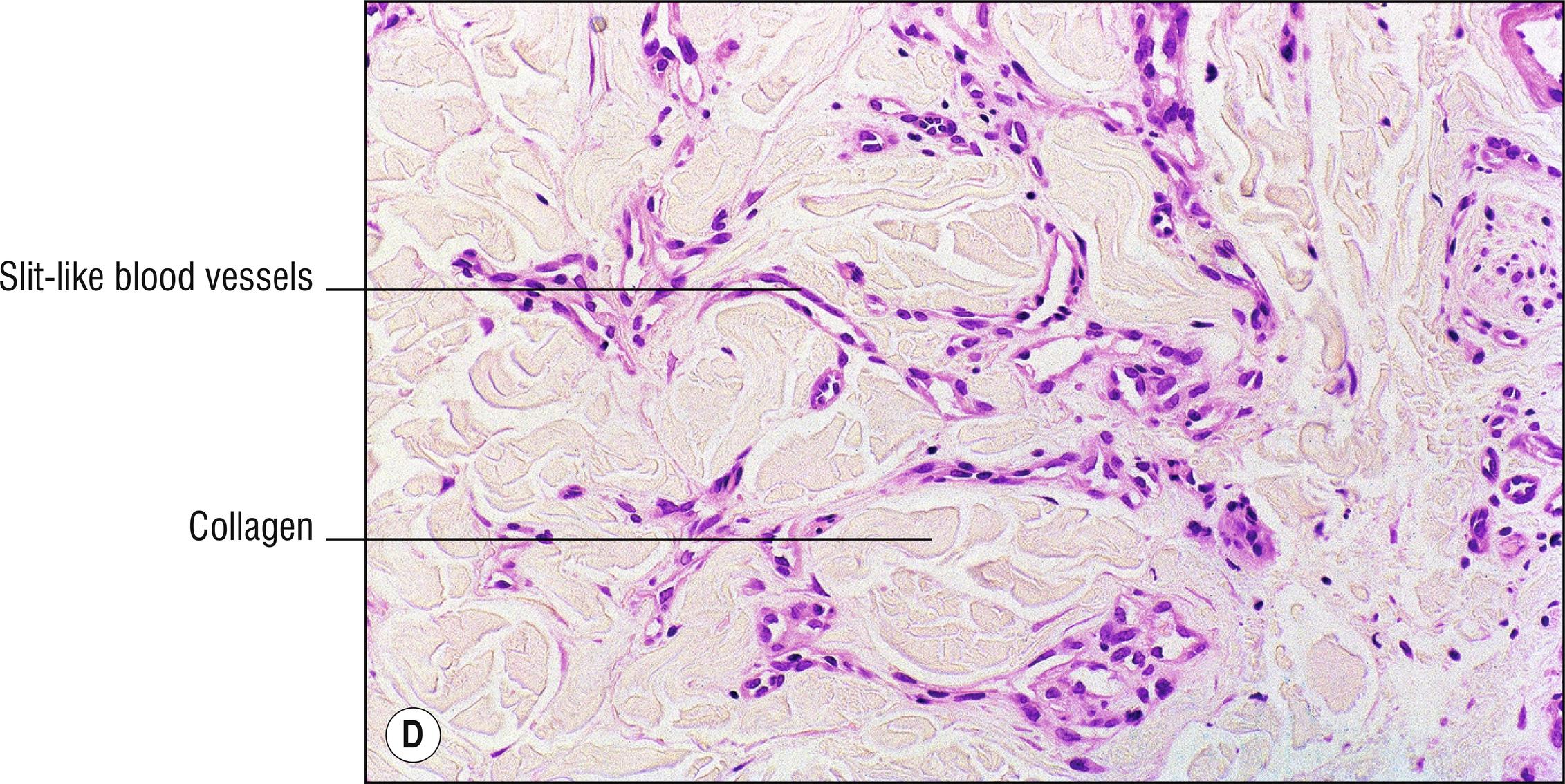 Fig. 25.1, D Microvenular hemangioma.