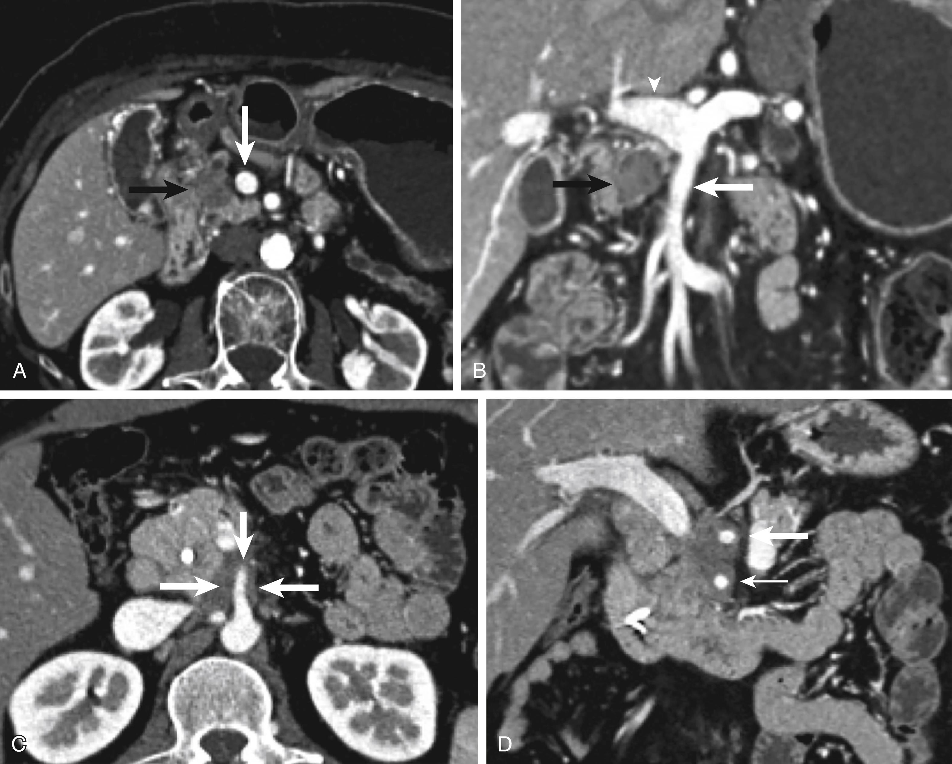 Figure 195.1, Portal Vein Invasion is Evaluated on Preoperative Computed Tomography (CT) Imaging.