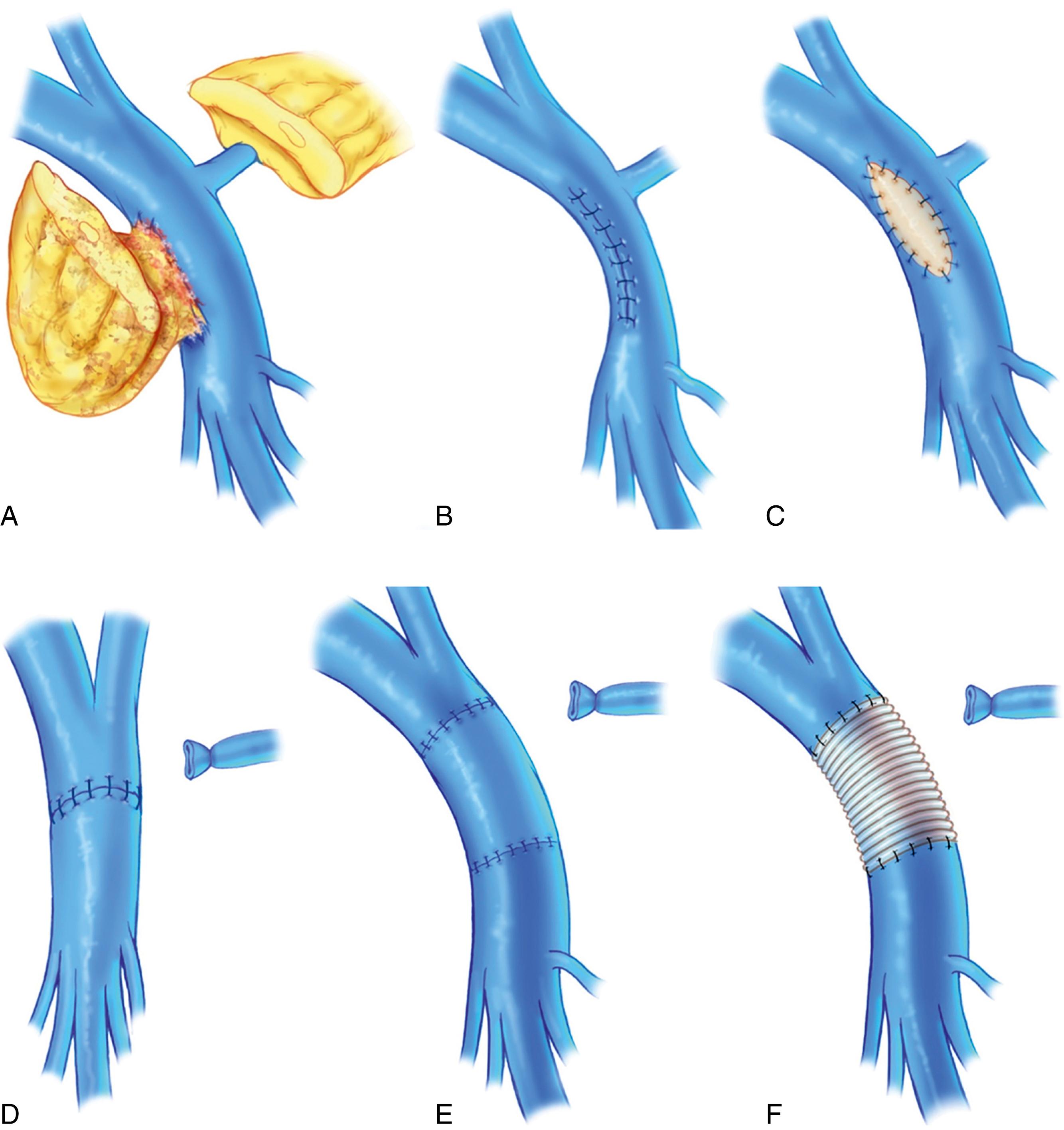 Figure 195.2, Methods of Portal Vein and Superior Mesenteric Vein Resection and Reconstruction During Pancreatectomy.