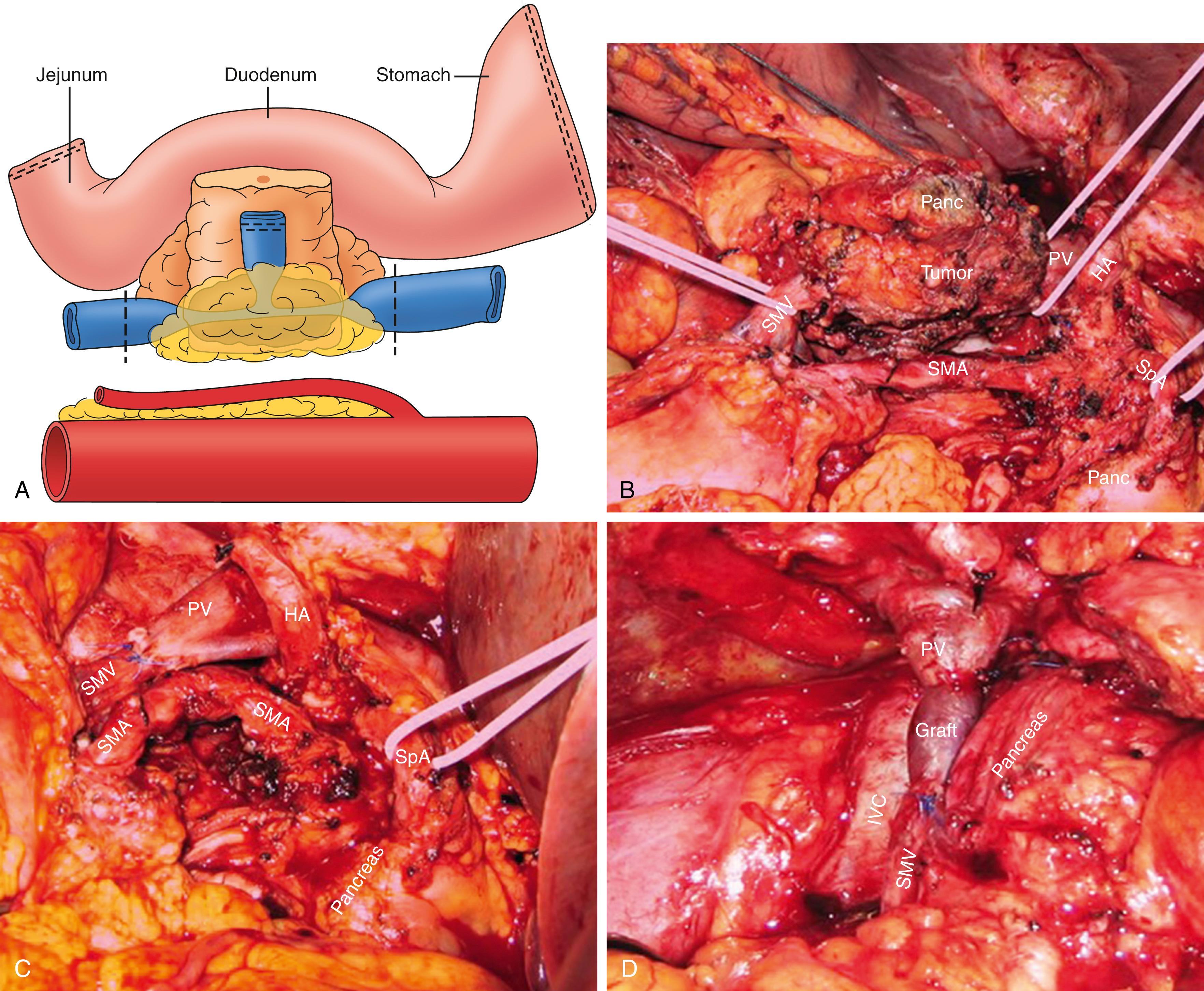 Figure 195.3, Portal Vein and Superior Mesenteric Vein Resection and Reconstruction During Pancreatectomy.