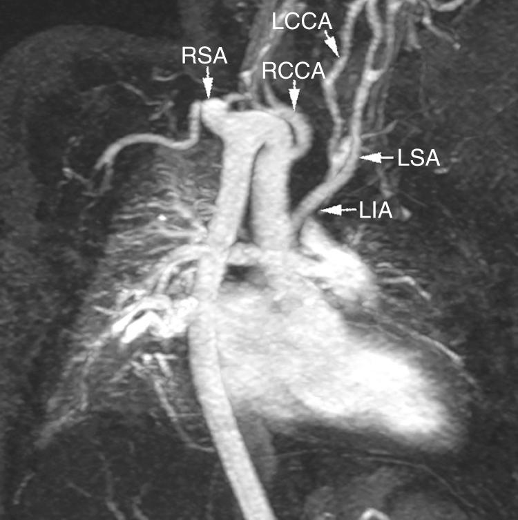 Fig. 47.11, Magnetic resonance angiogram showing a so-called cervical right aortic arch (RAA), which reaches to the apex of the right lung, where it makes a hairpin turn. It shows mirror-image branching, but the branches are tortuous, and the origin of the right subclavian artery is aneurysmally dilated. LCCA , Left common carotid artery; LIA , left innominate artery; LSA , left subclavian artery; RCCA , right common carotid artery; RSA , right subclavian artery.