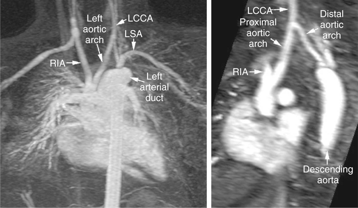 Fig. 47.12, Magnetic resonance angiograms showing that the severely hypoplastic cervical aortic arch, left-sided in this instance, reaches to the lower neck. It shows normal branching. Interruption of the aortic arch has been suspected in this patient, which could not be excluded at echocardiography. LCCA , Left common carotid artery; LSA , left subclavian artery; RIA , right innominate artery.