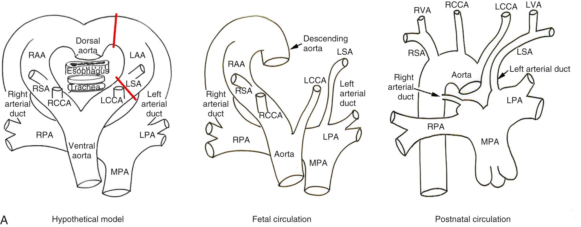 Fig. 47.13, (A) Hypothetical model for the double arch used to explain isolated origin of the left subclavian artery (LSA) from the left pulmonary artery (LPA) through the left arterial duct (left) . The red bars show regression of the left aortic arch (LAA) in two locations, both proximal and distal to the origin of the LSA. As the distal interruption is distal to the insertion of the left arterial duct, the LSA becomes isolated from the aortic arch, instead retaining its connection with the LPA. The right arterial duct also persists. The middle and right panels show the arrangements in the fetal and postnatal circulations. (B) Contrast-enhanced magnetic resonance angiograms reformatted in right anterior oblique (left), left anterior oblique (middle), and frontal (right) planes showing a right aortic arch (RAA) that gives rise to the left common carotid artery (LCCA), right common carotid artery (RCCA), and right subclavian artery (RSA) in sequence. The LSA arises from the proximal LPA through the left-sided arterial duct. The right arterial duct is patent between the right pulmonary artery (RPA) and the descending aorta. Note that the right arterial duct has an ampullary dilatation (asterisk) at its pulmonary arterial end. LVA , Left vertebral artery; MPA , main pulmonary artery; RPA , right pulmonary artery; RVA , right vertebral artery.