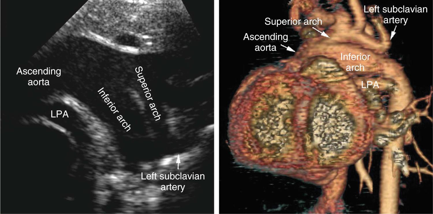 Fig. 47.14, Computed tomograms showing a double-barreled aortic arch in a patient with tetralogy of Fallot and pulmonary atresia. LPA , Left pulmonary artery.