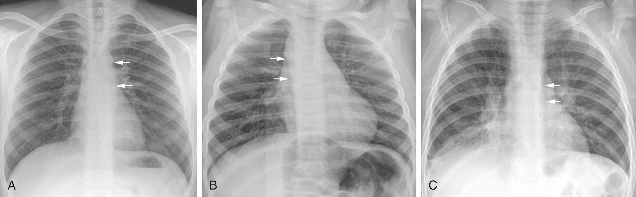 Fig. 47.15, Frontal chest radiographs showing a normal left aortic arch (LAA; A) and a right aortic arch (RAA; B). The trachea shows slight indentation on the same side of the aortic arch and is bent slightly to the other side when there is an LAA or RAA. The aortic arch can be traced downward to the vertical linear stripe of the descending aorta on the same side (arrows) . In the setting of a double aortic arch (C), the distal trachea shows narrowing on both sides. In this case the descending aorta can be traced down the left side (arrows) and pneumonic consolidation is seen in the right middle lobe (C).