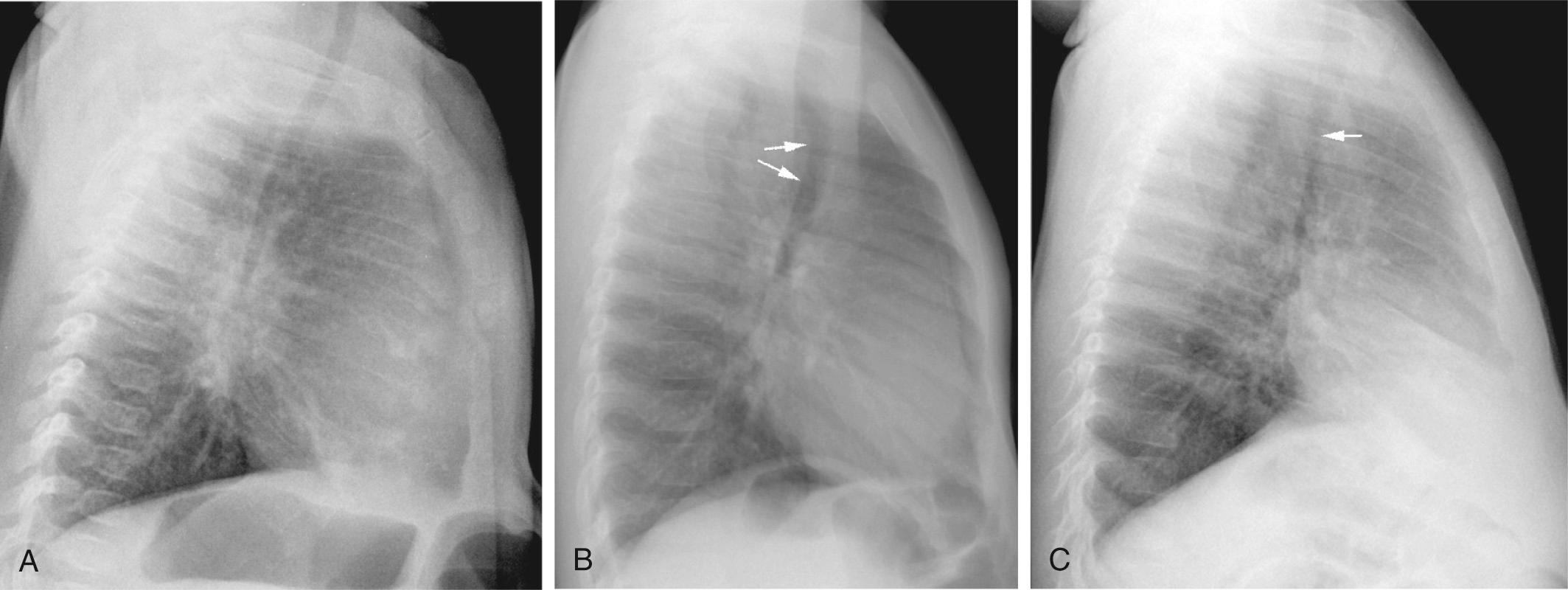 Fig. 47.16, Lateral chest radiographs, corresponding to those shown in Fig. 47.15 , show (A) a normal left aortic arch and a normal trachea, which takes a straight course without narrowing. (B) When the aortic arch is right sided and an aberrant left subclavian artery arises from a diverticulum of Kommerell, the trachea is bowed forward by the diverticulum (arrows) . (C) In the setting of a double aortic arch, the distal trachea in this case shows diffuse narrowing (arrow) , and pneumonic consolidation is seen in the right middle lobe.