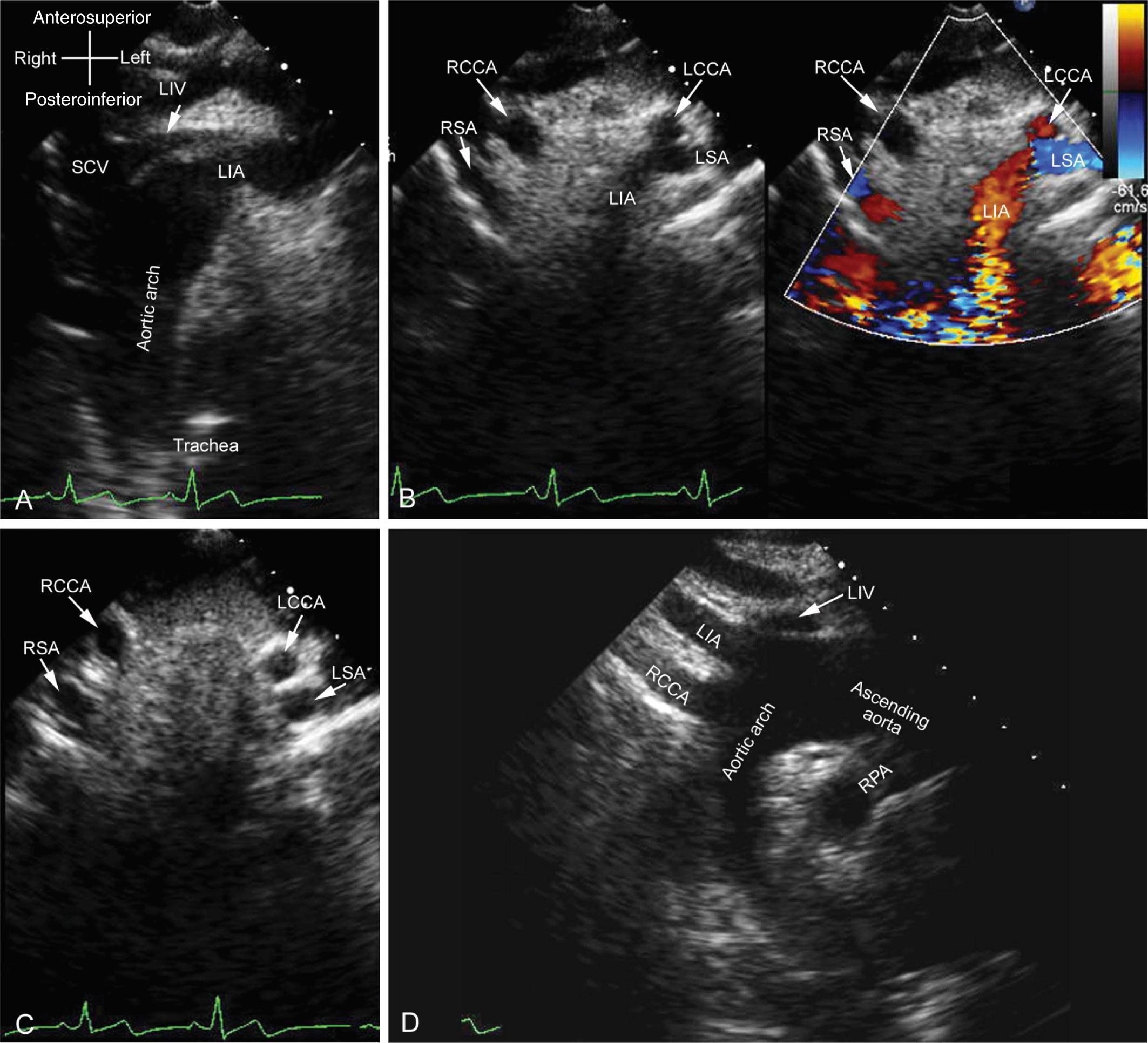 Fig. 47.17, Standardized echocardiographic approach to show the anatomy of the aortic arch in a patient with right aortic arch (RAA) and mirror-image branching. The position of the aortic arch relative to the trachea is identified in a downward tilted transverse view from a suprasternal approach (A). Sweeping upward with the transducer permits ascertainment of the origins of the brachiocephalic arteries (B). The first branch in this case is the left brachiocephalic artery (LBA), which bifurcates into the left common carotid artery (LCCA) and left subclavian artery (LSA). With a further sweep upward, the carotid and subclavian arteries can be imaged in an almost symmetric arrangement in the lower neck (C). The transducer is rotated clockwise or counterclockwise to align the ascending and descending aorta with the aortic arch (D). In this instance, the sonographer has mirror-imaged the transducer clearly to demonstrate that there is an RAA. LIA , Left innominate artery; LIV , left innominate vein; RCCA , right common carotid artery; RPA , right pulmonary artery; RSA , right subclavian artery; SCV , superior caval vein.