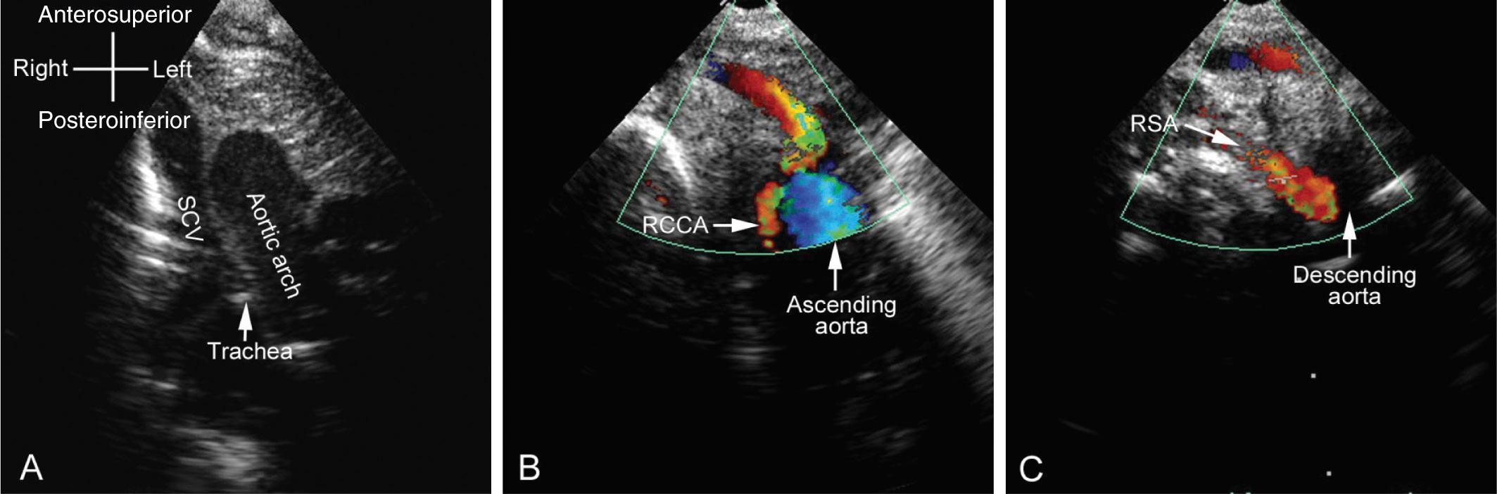 Fig. 47.18, Echocardiographic images showing a left aortic arch (LAA) with an aberrant right subclavian artery (RSA). (A) In the downward transverse view an LAA is displayed with the trachea to the right. (B) The upward sweep of the transducer reveals that the first branch arising from an LAA does not bifurcate but instead continues forward, upward, and rightward, this being characteristic for the right common carotid artery (RCCA). (C) Inferior angulation of the transducer reveals the aberrant RSA arising more distally from the descending aorta on the left side of the midline. SCV , Superior caval vein.