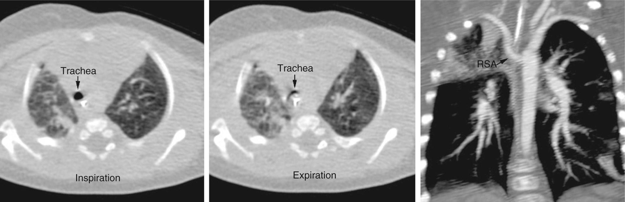 Fig. 47.19, Dynamic computed tomographic axial images obtained in inspiration and expiration phases showing that the trachea is collapsed during expiration. As shown at right, the patient has an aberrant right subclavian artery (RSA).