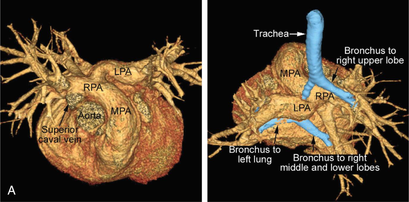 Fig. 47.20, (A) Volume-rendered computed tomographic angiograms seen from the front and above (left) and from behind and above (right) show a pulmonary arterial sling with abnormal tracheobronchial branching and stenosis. The left pulmonary artery (LPA) arises from the proximal right pulmonary artery (RPA), makes a hairpin turn around the airway in the mediastinum and courses to the hilum of the left lung. The airway has two bifurcations in the mediastinum, with a narrow intermediary segment, characteristic of congenital stenosis due to complete cartilaginous rings. (B) This diagram showing a pulmonary arterial sling also illustrates a left-sided arterial ligament connecting the distal LPA to the descending aorta. (C) Chest radiographs are shown together with computed tomographic correlation of a pulmonary arterial sling. The diagnosis can be entertained when careful observation shows the abnormality seen in the chest radiograph. The arrows indicate the narrowed vertical segment of trachea between its upper and lower bifurcations. MPA , Main pulmonary artery.