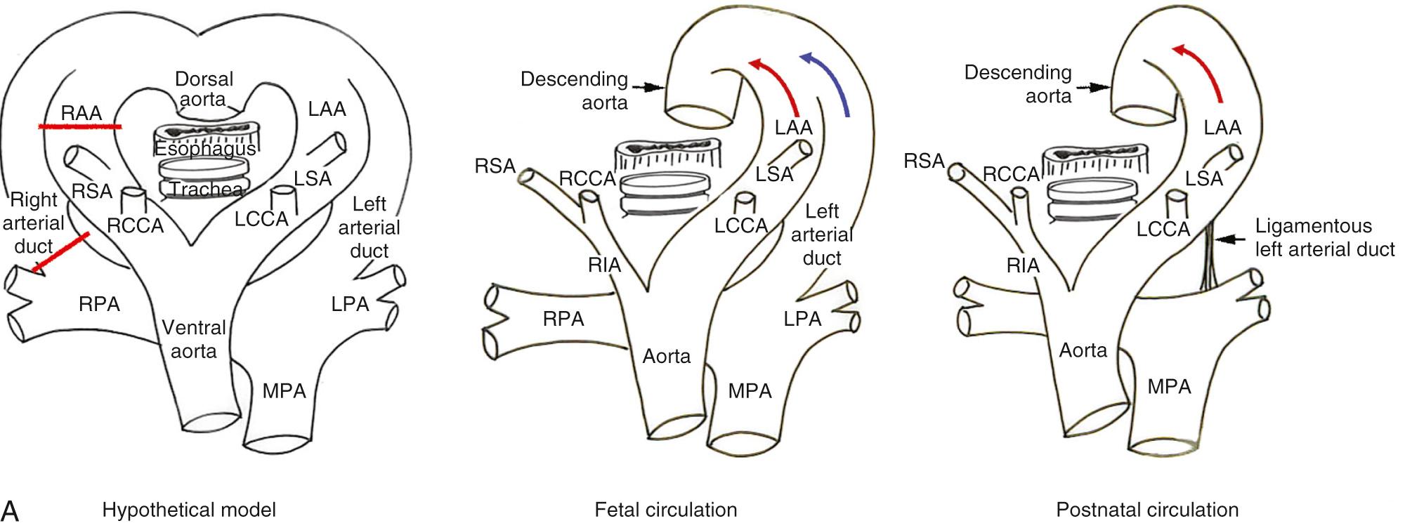 Fig. 47.2, (A) Steps involved in normal formation of a left-sided aortic arch with a left arterial duct. In the model of the hypothetical double arch, as shown at left, the red bars indicate the segments that regress. In the normal left-sided aortic arch, shown at right, this results in disappearance of the right aortic arch (RAA) distal to the origin of the right subclavian artery (RSA), along with right-sided arterial duct regress. In the fetal circulation, as shown in the middle diagram, the aortic arch (red arrow) and the left arterial duct (blue arrow) make a V-shaped confluence at the descending aorta. In the postnatal circulation, the left arterial duct closes, becoming the arterial ligament or the ligamentous arterial duct. (B) The fetal echocardiogram across the upper mediastinum shows the normal left aortic arch (LAA) and left-sided arterial duct, forming a V-shaped confluence at their union to form the descending aorta. (C) The volume-rendered magnetic resonance angiogram seen from the front (left) and the computed tomographic angiogram seen from above (right) show the normal arrangement of the left-sided aortic arch, which gives rise sequentially to the brachiocephalic, left common carotid artery (LCCA), and left subclavian artery (LSA). LV , Left ventricle; LPA , left pulmonary artery; MPA , main pulmonary artery; RA , right atrium; RV , right ventricle; RCCA , right common carotid artery; RIA , right innominate artery; RPA , right pulmonary artery; SCV , superior caval vein.