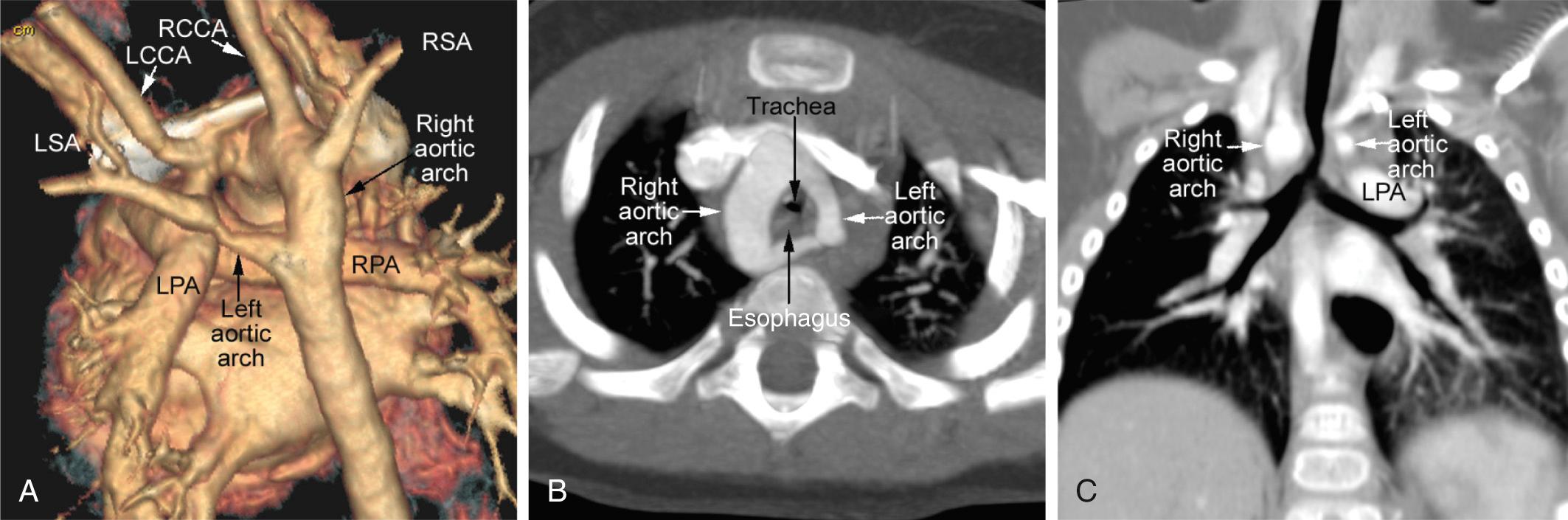 Fig. 47.3, Computed tomograms showing a complete double arch, are seen from behind and above (A) and below (B). The double arch encircles the trachea and esophagus, with the right arch dominant. The reformatted image in the coronal plane (C) shows narrowing of the trachea due to compression by the dominant right aortic arch (RAA). The trachea is slightly bent to the left. LCCA , Left common carotid artery; LPA , left pulmonary artery; LSA , left subclavian artery; RCCA , right common carotid artery; RPA , right pulmonary artery; RSA , right subclavian artery.