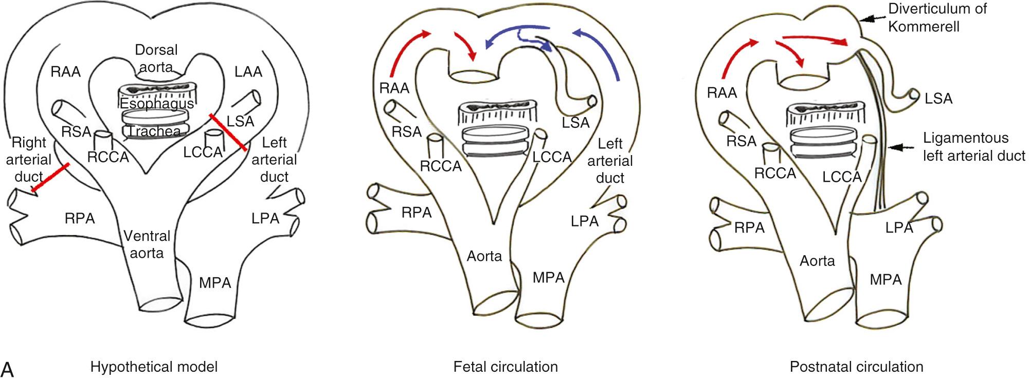 Fig. 47.4, (A) Mode of formation of a right aortic arch (RAA) with aberrant origin of the left subclavian artery (LSA) and a left-sided arterial duct. In this and the subsequent panels formatted in this fashion, the hypothetical model of the double arch is shown at left, with the red bars indicating the segments that will regress. The middle diagram shows the situation in the fetal circulation. In this variant, the RAA, along with the remnant of the distal left aortic arch (LAA), the left-sided arterial duct, and the pulmonary trunk (PT), produce a U-shaped vascular loop around the trachea and esophagus. As the two limbs of the U-shaped loop are attached to the heart, this produces a complete vascular ring. In the postnatal circulation, shown at right, consequent to closure of the arterial duct, the proximal part of the aberrant LSA, representing the distal remnant of the LAA, usually persists as the so-called diverticulum of Kommerell. Note that the flow of blood in this distal remnant of the LAA reverses direction after birth. (B) Fetal echocardiograms illustrating the situation diagrammed in Fig. 47.6 show a U-shaped vascular loop around the trachea. Note the extent of the gap between the ascending aorta and the PT. (C) Computed tomograms showing an RAA with an aberrant LSA arising from a diverticulum of Kommerell. At right, the expected location of the ligamentous arterial duct is marked with a red bar. Note the mild compression of the distal trachea. LCCA , Left common carotid artery; LPA , left pulmonary artery; MPA , main pulmonary artery; RCCA , right common carotid artery; RPA , right pulmonary artery; RSA , right subclavian artery; SCV , superior caval vein.