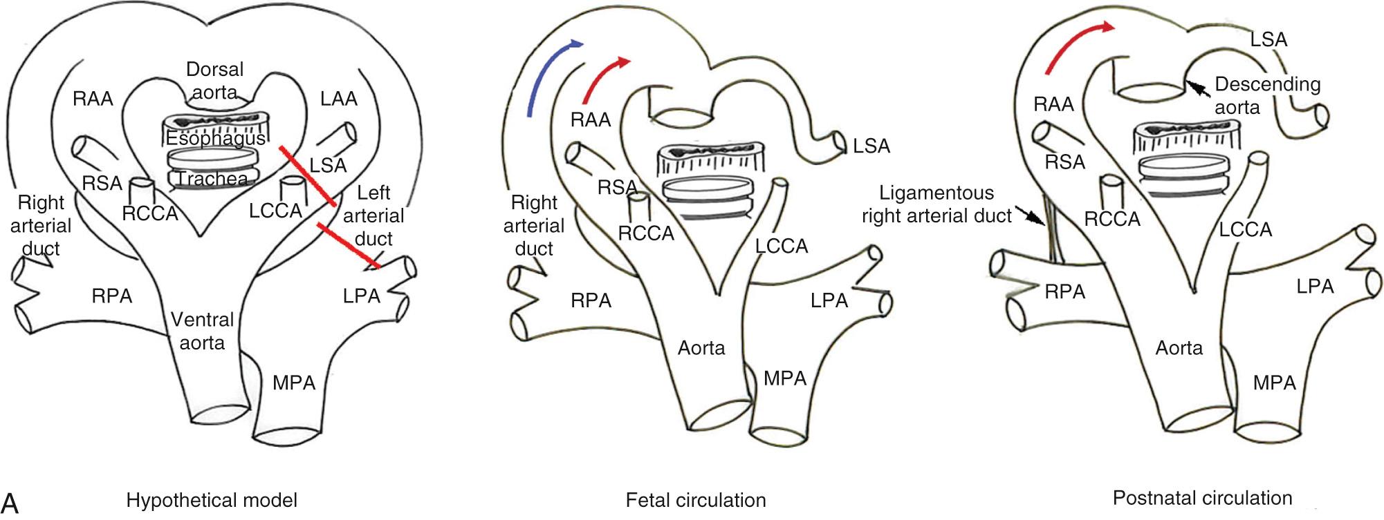 Fig. 47.5, (A) Mode of formation of right aortic arch (RAA) with aberrant left subclavian artery (LSA) and right-sided arterial duct. In the fetal and postnatal circulations, this arrangement produces a vascular sling on the right side of the trachea and esophagus. This is a rare combination. (B) These computed tomograms show an RAA with aberrant origin of the LSA but no arterial duct in a newborn with tetralogy of Fallot and pulmonary atresia. The computed tomograms in axial and coronal planes show that the RAA gives rise to the aberrant LSA with no intervening diverticulum of Kommerell. The pulmonary arteries were nonconfluent, with the pulmonary circulation supplied by major aortopulmonary collateral arteries (MAPCA), with congenital absence of both arterial ducts. LAA , Left aortic arch; LCCA , left common carotid artery; LPA , left pulmonary artery; MPA , main pulmonary artery; RCCA , right common carotid artery; RPA , right pulmonary artery; RSA , right subclavian artery; SCV , superior caval vein.